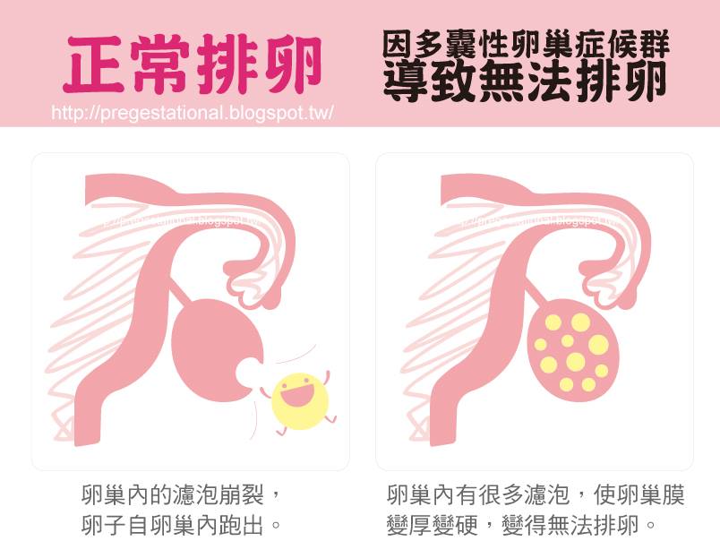 圖4.正常與多囊的差異