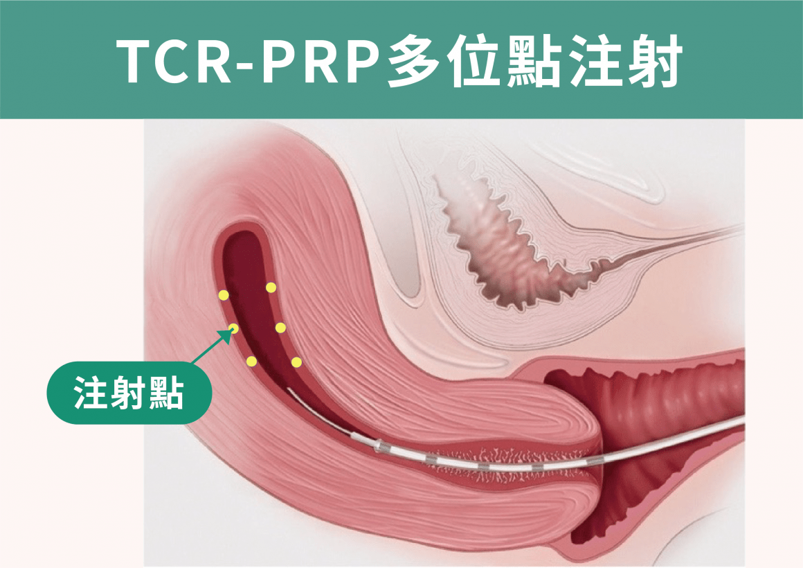 新一代子宮內膜內注射TCR-PRP 新一代子宮內膜內注射TCR-PRP
