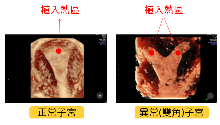 4D 超音波 助於醫師判斷胚胎植入位置 4D 超音波 助於醫師判斷胚胎植入位置