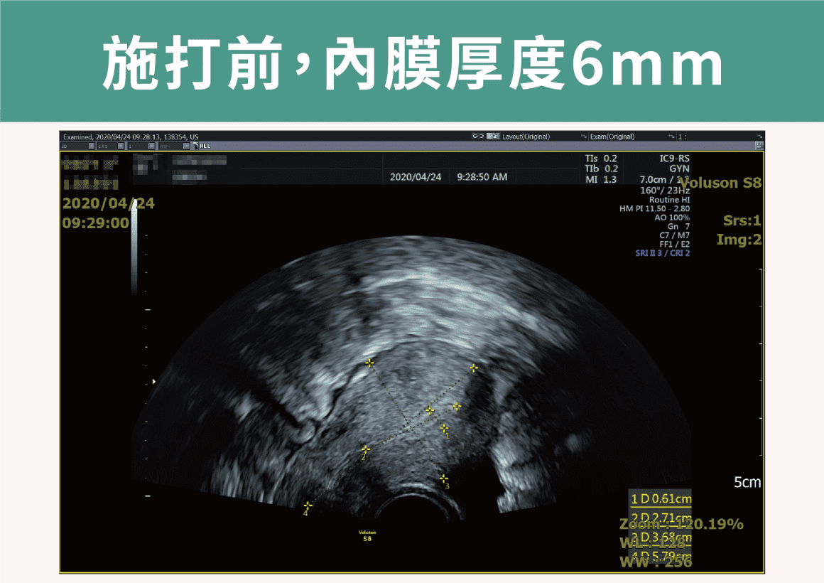 茂盛醫院-施打前子宮內膜厚度6mm (1) 茂盛醫院-施打前子宮內膜厚度6mm (1)