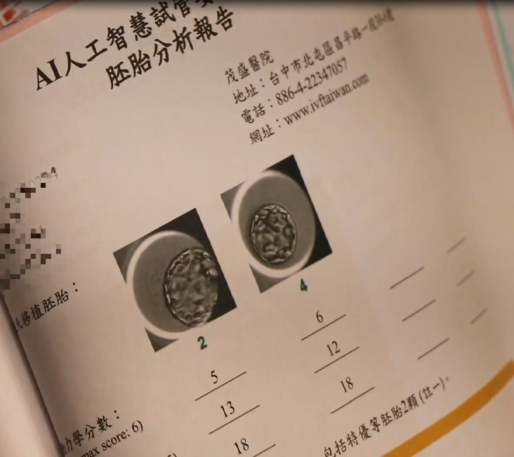 茂盛醫院使用無痛取精療法協助逆行性射精患者得子