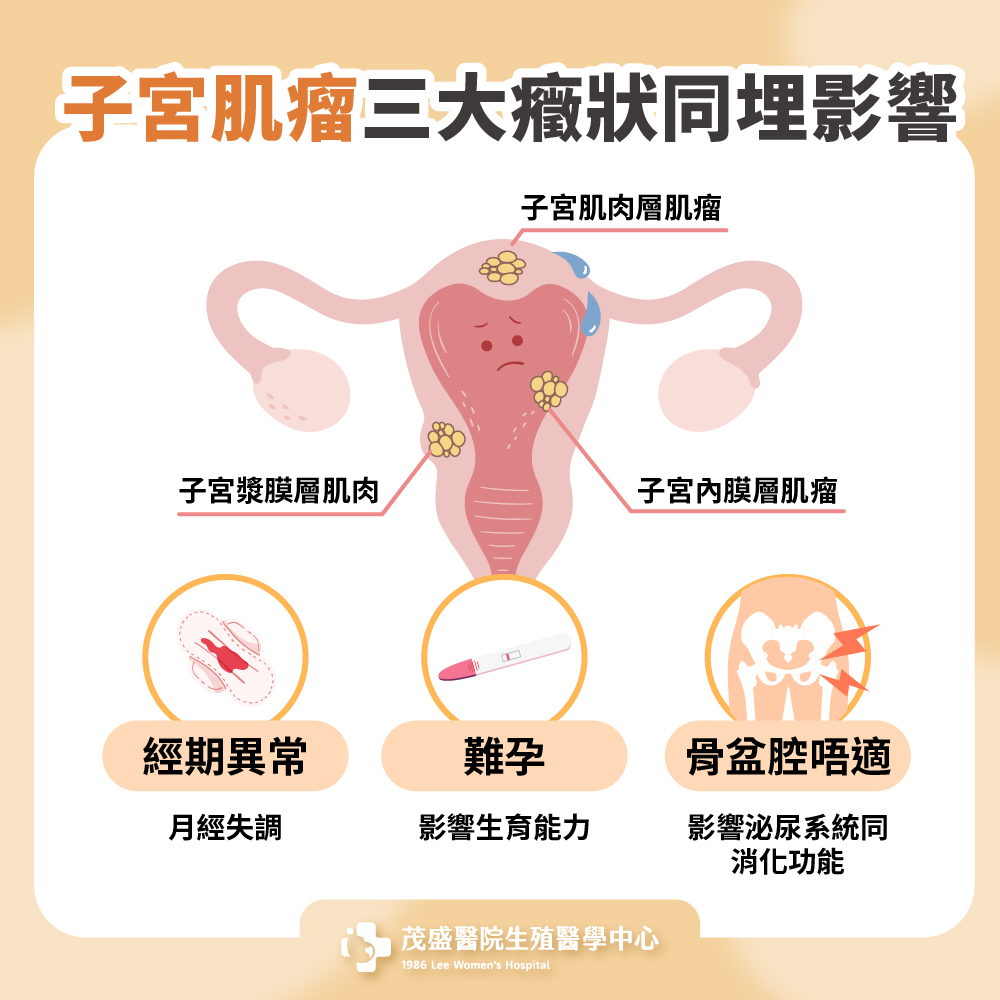 子宮肌瘤三大癥狀同埋影響