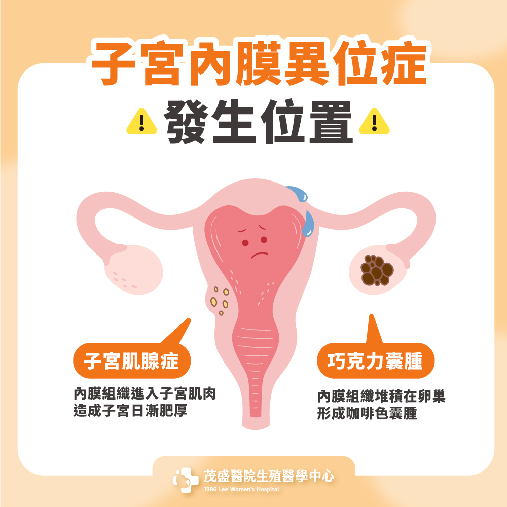 子宮內膜異位症發生位置