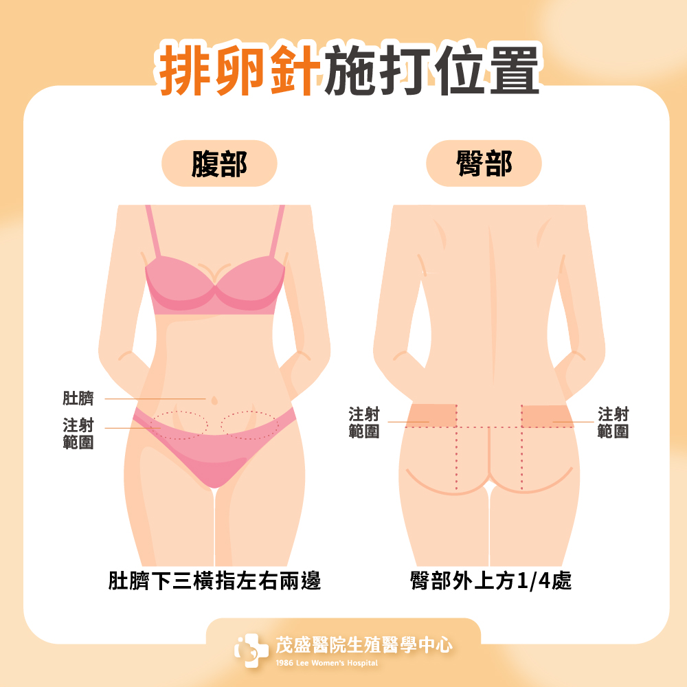 排卵針施打位置