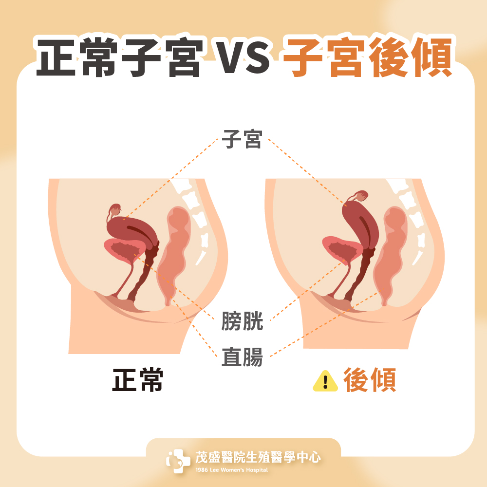 正常子宮VS子宮後傾