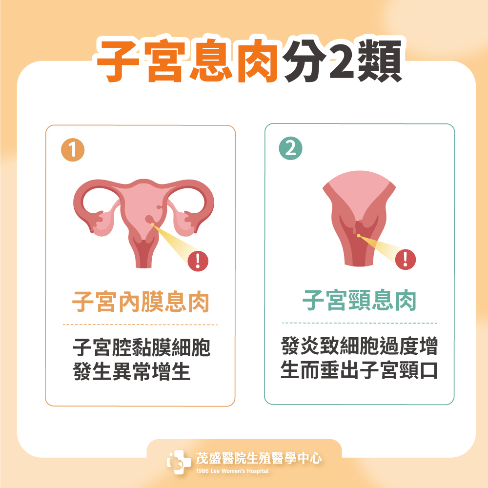 子宮息肉分2類